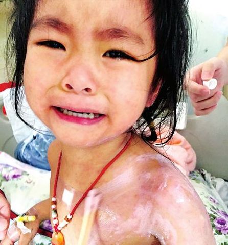 3歲的蘭蘭，全身紅疹，因疼癢難忍而大哭