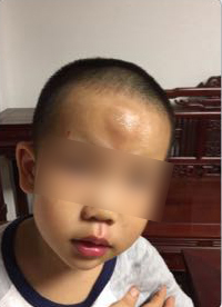 男童被送快遞的電動車撞飛一米多，額頭腫起乒乓球大的包